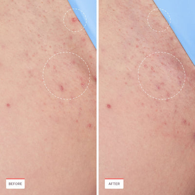 Smoothing Solution for Ingrown Hair Treatment